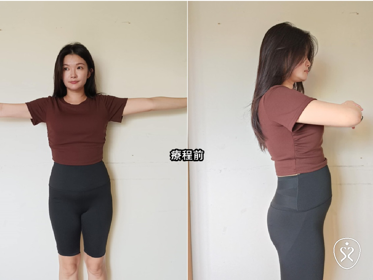 善纖達療程是一套漸進式的療程,需要按照醫師指示定期施打,才能維持唷